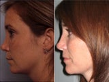 Rhinoplasty revision