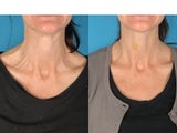 Botox for Neck Bands