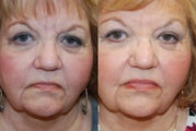 Non-Surgical Facial Rejuvenation with Silikon-1000