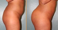 Brazilian Butt Lift