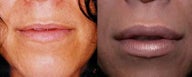 Lip Augmentation