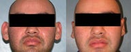 Otoplasty