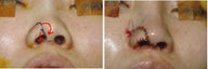 Nostril notch reapir