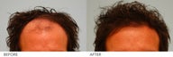 Hair Transplant 