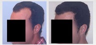 Hair Transplant