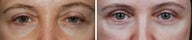Ptosis Patient