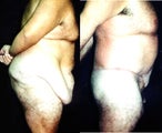 Belt lipectomy - extended abdominoplasty