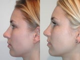 Rhinoplasty