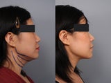 Smart Lipo