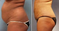 Smart Lipo