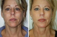 Neck Lift, Neck Lipo, Chin Implant