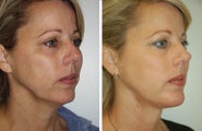 Neck Lift, Neck Lipo, Chin Implant
