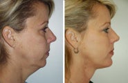Neck Lift, Neck Lipo, Chin Implant
