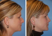 Rhinoplasty