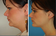 Neck Lift, Neck Lipo