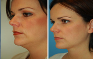 Neck Lift, Neck Lipo