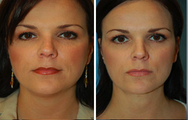 Neck Lift, Neck Lipo