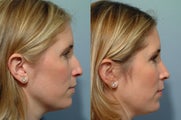 Rhinoplasty