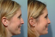 Rhinoplasty
