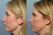 Rhinoplasty