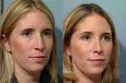 Rhinoplasty