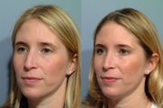 Rhinoplasty
