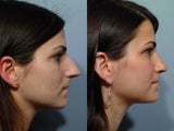 Rhinoplasty