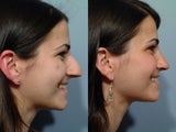 Rhinoplasty