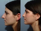 Rhinoplasty