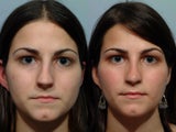 Rhinoplasty