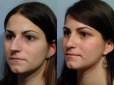 Rhinoplasty