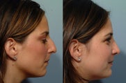 Rhinoplasty