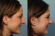Rhinoplasty