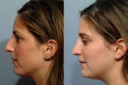 Rhinoplasty