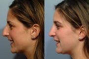 Rhinoplasty