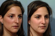 Rhinoplasty