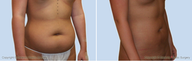 Liposuction