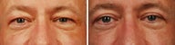 Upper Eyelid Blepharoplasty