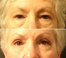 Eyelid Surgery