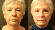 Mid Facelift