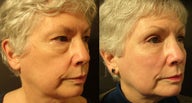 Mid Facelift