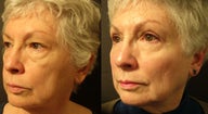 Mid Facelift