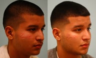 Scar Revision