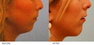 Chin Implant