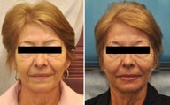 Restylane and Perlane used to volumize the entire face. 