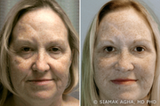 Facelift