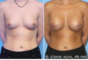 Breast Augmentation