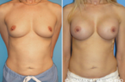 Breast Augmentation