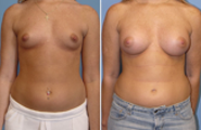 Breast Augmentation