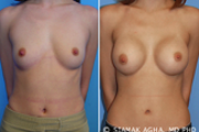 Breast Augmentation
